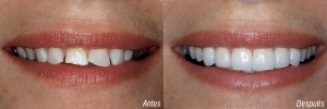 Carillas-dentales-Edad-para-usar